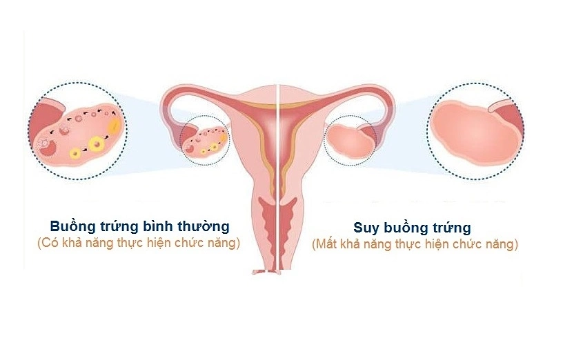 Báo động tình trạng Suy buồng trứng sớm ở tuổi 30: Nguyên nhân do đâu?