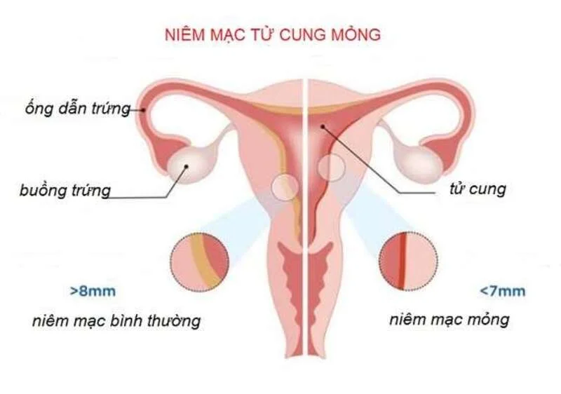 Niêm mạc tử cung: “Mảnh đất vàng” quyết định điều gì trên hành trình đón con yêu?