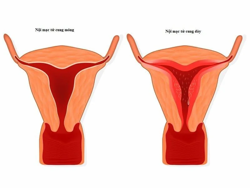 Niêm mạc tử cung: “Mảnh đất vàng” quyết định điều gì trên hành trình đón con yêu?